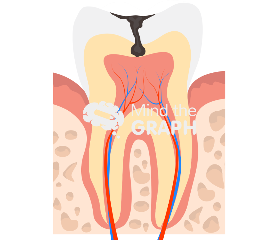 Tooth decay cavity Icons, Symbols, Pictures, and Images